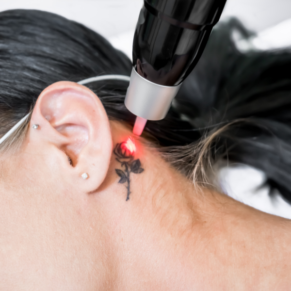 Tattoo #Removal / SPMU Correction