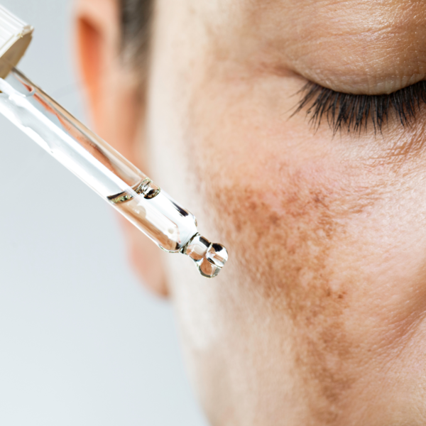 Melasma Removal