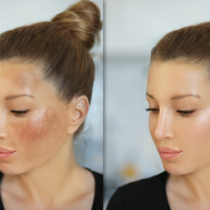 Melasma, Freckles, Dark Spot Removal