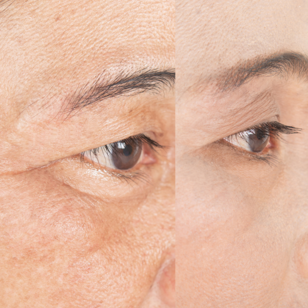 Saggy Eyes Reduction